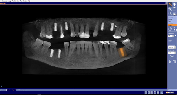 CT SCAN – 3D DENTAL CONE BEAM