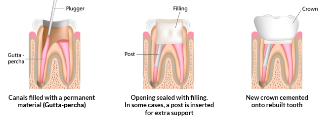 Root Canal procedure