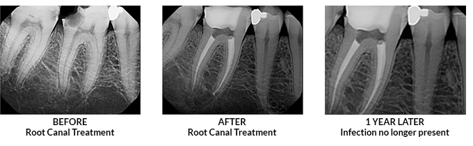 ROOT CANAL THERAPY