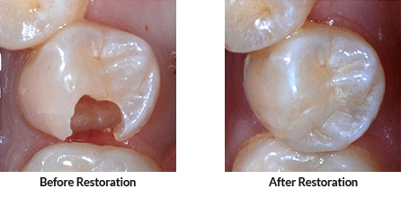 Filling procedure BA