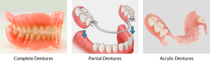 TYPES OF DENTURES