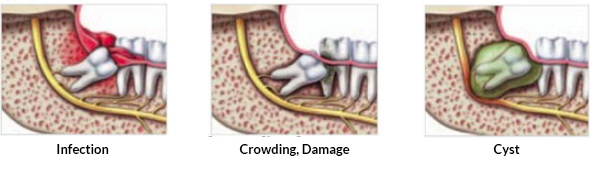 wisdom teeth are growing correctly or not