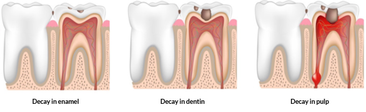 Decay down to the pulp