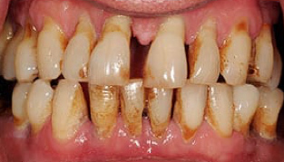 Advanced Periodontitis