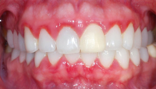 Gingivitis