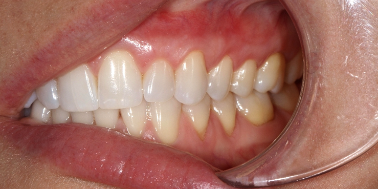 Gum Recession