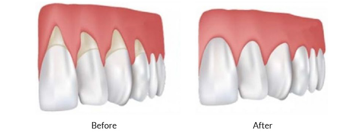 GUM RECESSION TREATED