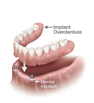 BENEFITS OF IMPLANT RETAINED DENTURES
