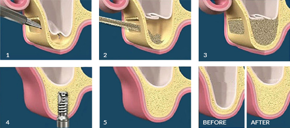 Sinus lift surgery