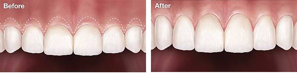 Crown Lengthening