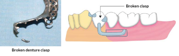 Broken Denture clasp