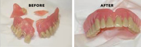 Broken or chipped tooth in denture