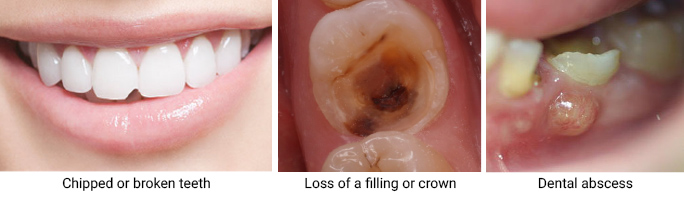 Dental abscess