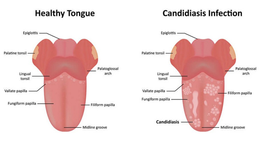 ORAL THRUSH