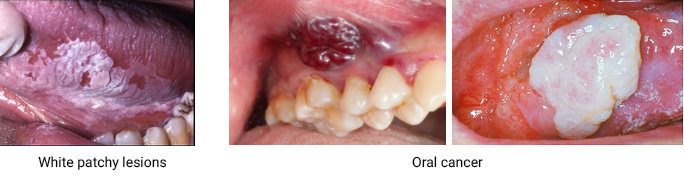 ORAL CANCER