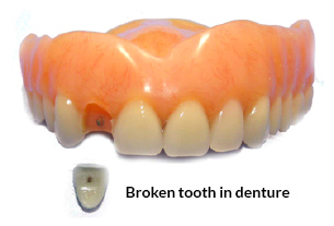 Broken Tooth in Denture