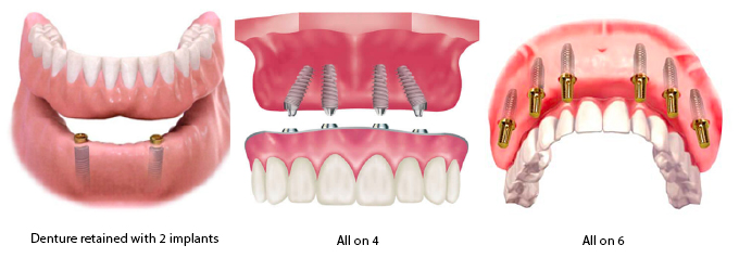 FULL MOUTH REHABILITATION TREATMENTS