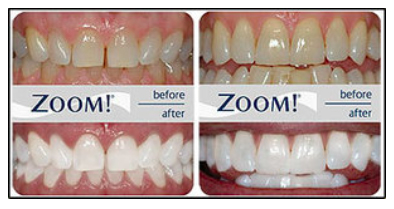 Zoom! TEETH WHITENING BA