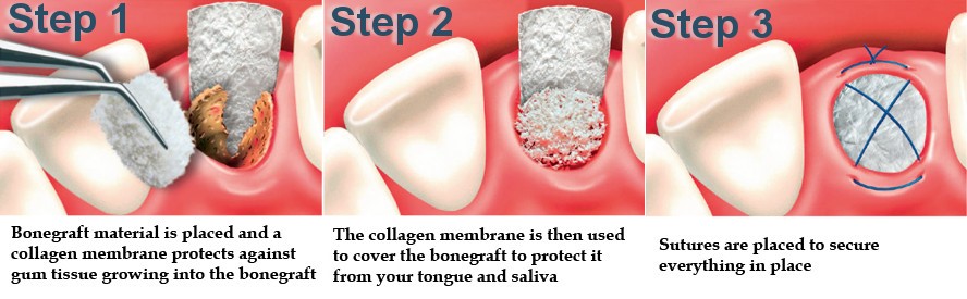 SOCKET BONE GRAFT