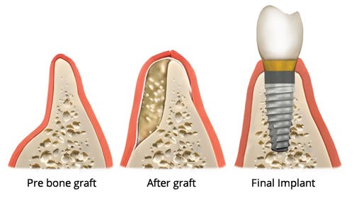 BONE GRAFT