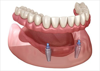 Implant retained Dentures