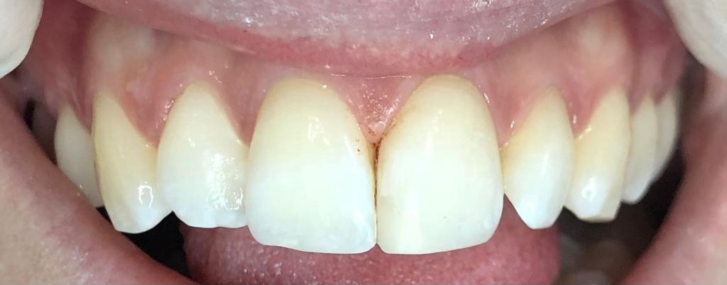 Fillings After