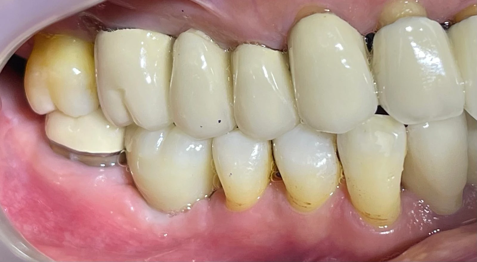 After Dental Implant