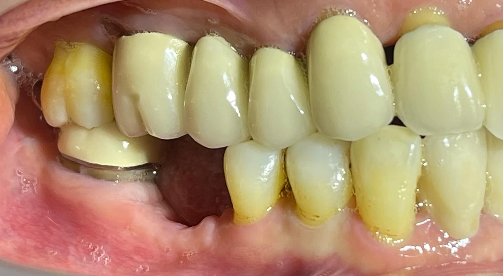 Before Dental Implant